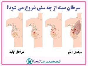 سرطان سينه