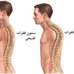 قوز کمر