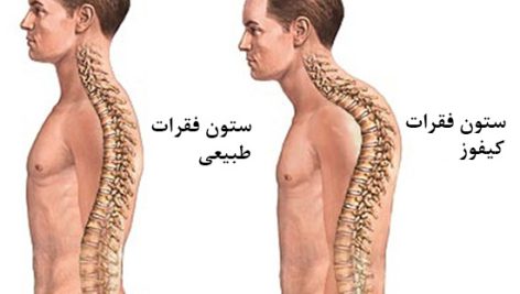 قوز کمر