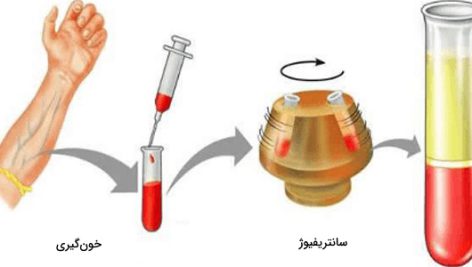 هماتوكريت