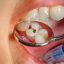 کربوهیدراتها و پوسیدگی دندان